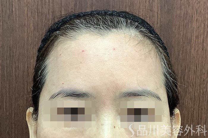 症例NO.67780のAFTER写真