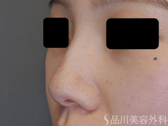 症例NO.69601のAFTER写真
