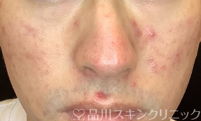 症例NO.69608のBEFORE写真