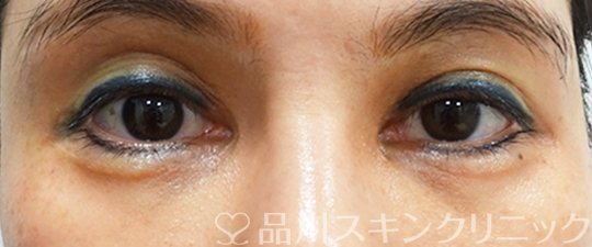 症例NO.70105のBEFORE写真