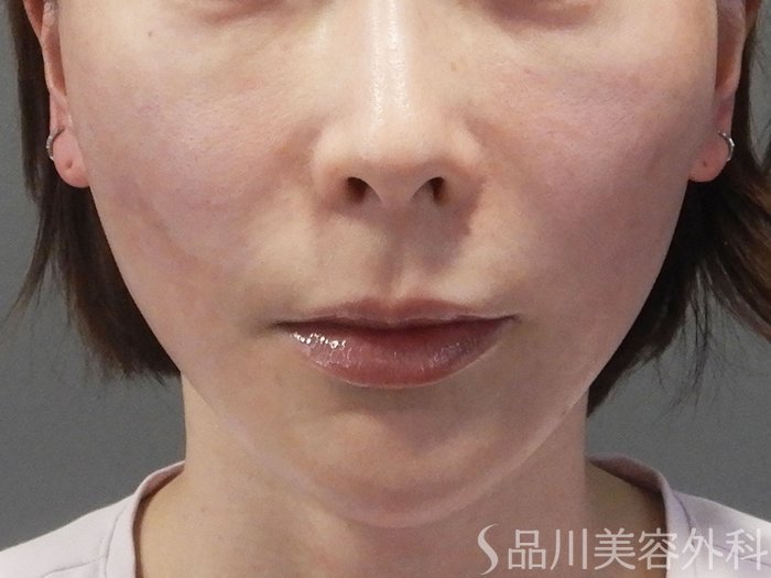 症例NO.70138のAFTER写真