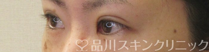 症例NO.73935のAFTER写真