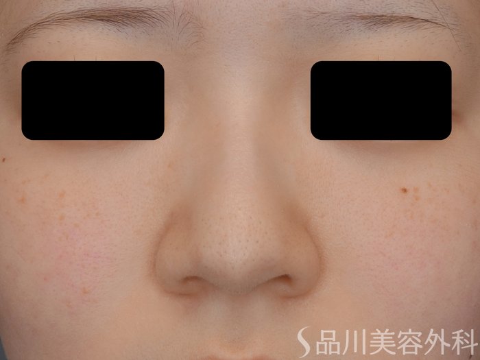 症例NO.71071のBEFORE写真