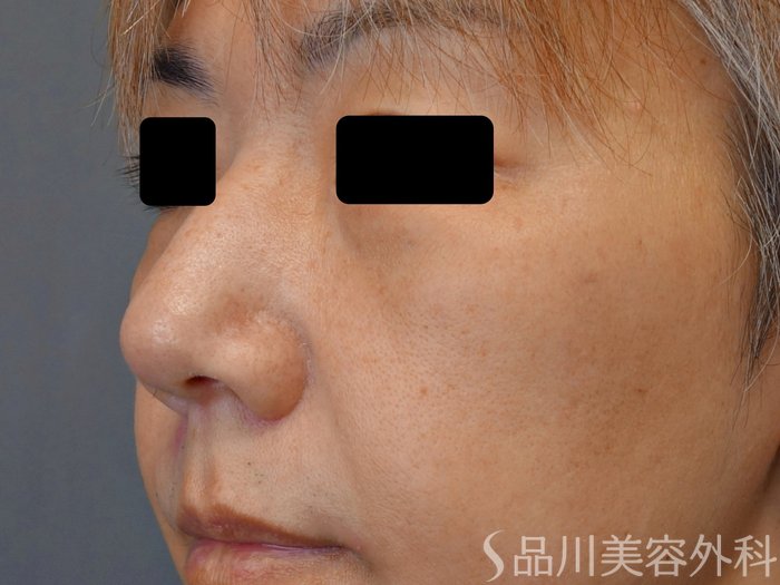 症例NO.74097のBEFORE写真