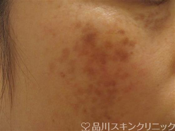症例NO.38042のBEFORE写真
