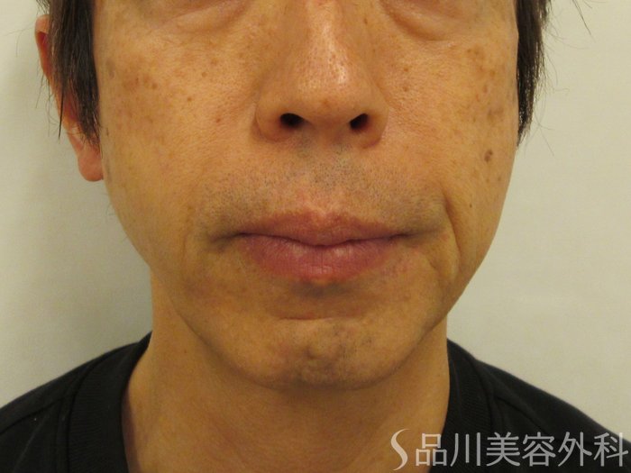 症例NO.75115のBEFORE写真