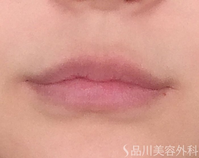 症例NO.70085のBEFORE写真