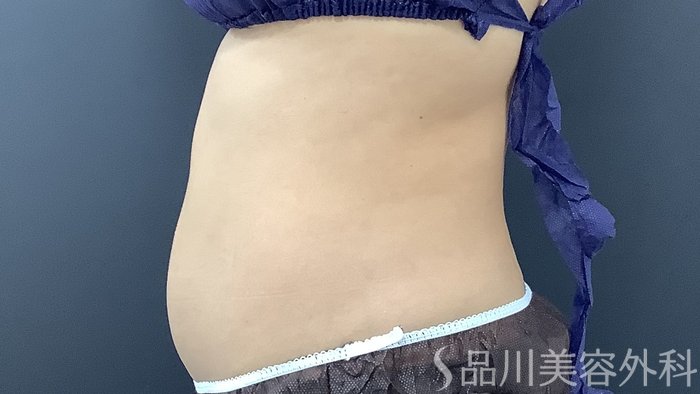 症例NO.75392のAFTER写真
