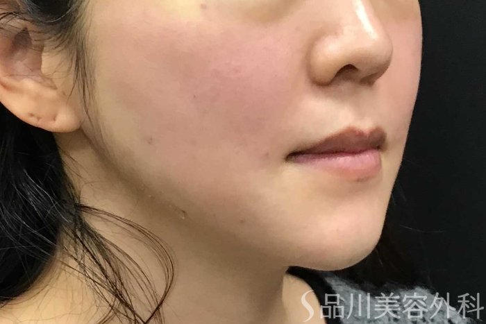 症例NO.63013のAFTER写真