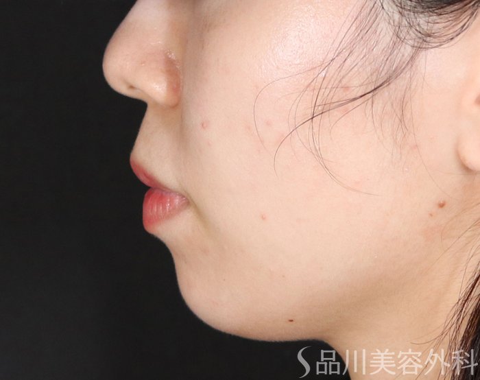 症例NO.71979のBEFORE写真