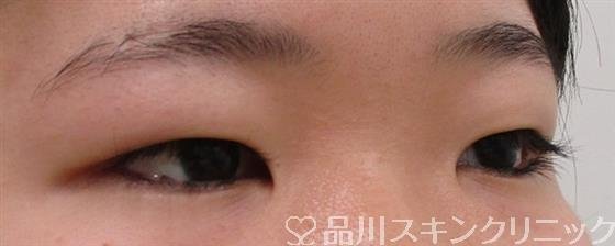 症例NO.41630のBEFORE写真