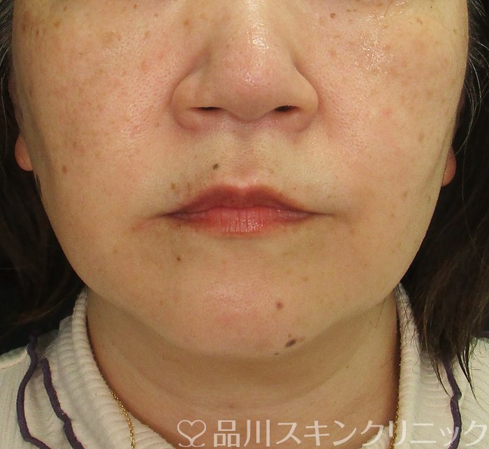 症例NO.73187のAFTER写真