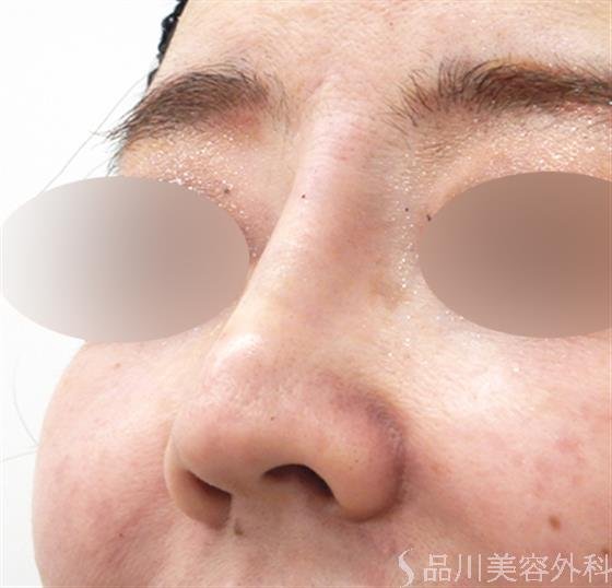 症例NO.53639のAFTER写真