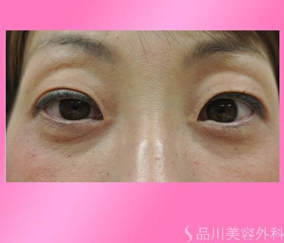 症例NO.14560のBEFORE写真