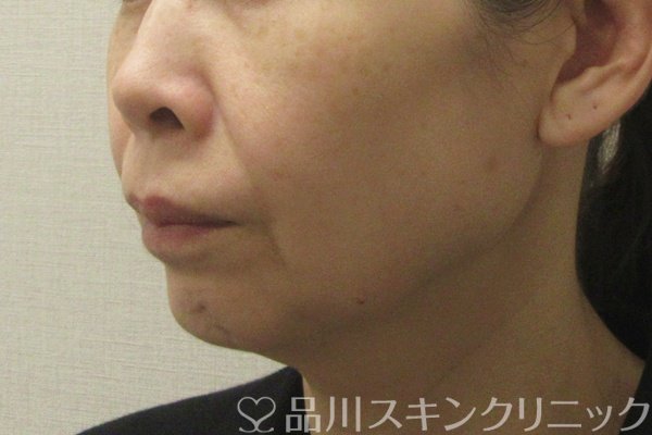 症例NO.74830のBEFORE写真