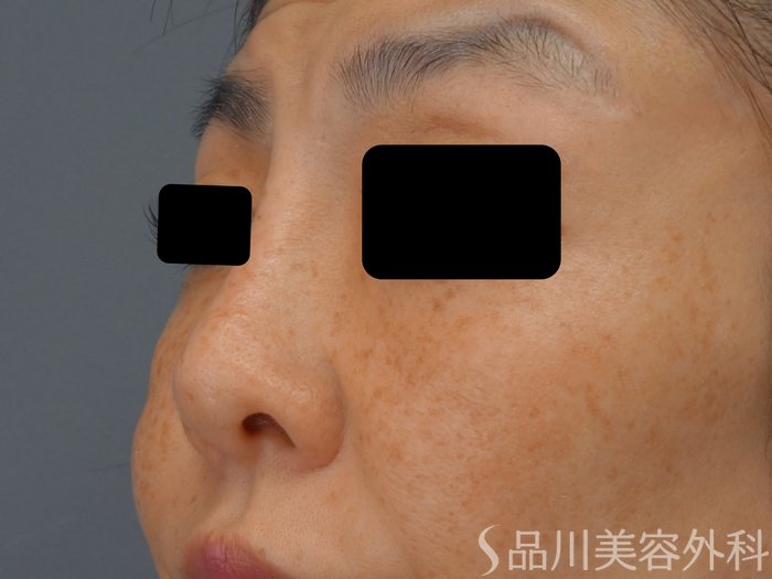 症例NO.74557のBEFORE写真