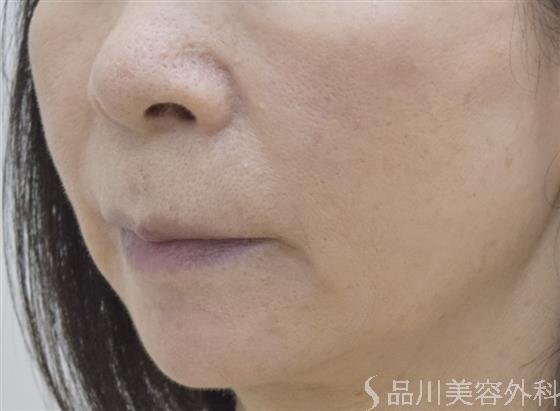 症例NO.49184のAFTER写真