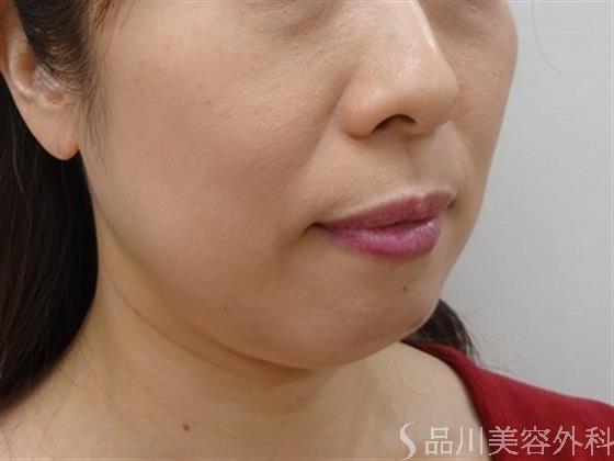 症例NO.41460のBEFORE写真