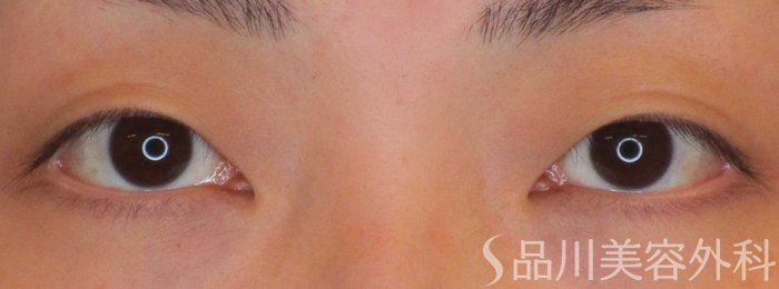 症例NO.64948のBEFORE写真