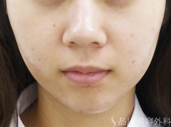 症例NO.24281のAFTER写真