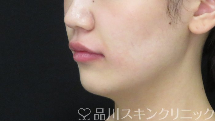 症例NO.72370のAFTER写真