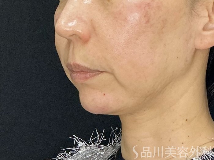 症例NO.72573のAFTER写真