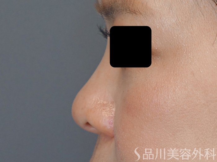 症例NO.67755のBEFORE写真