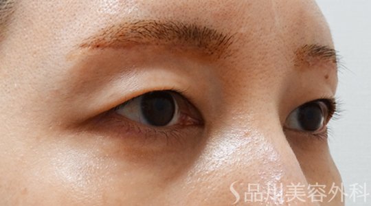 症例NO.70162のAFTER写真