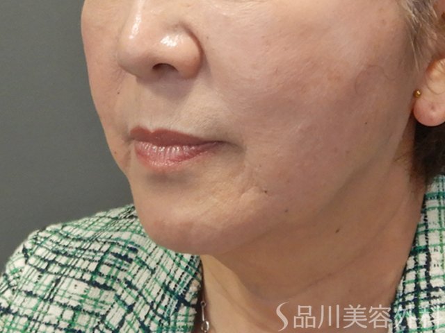 症例NO.74256のAFTER写真