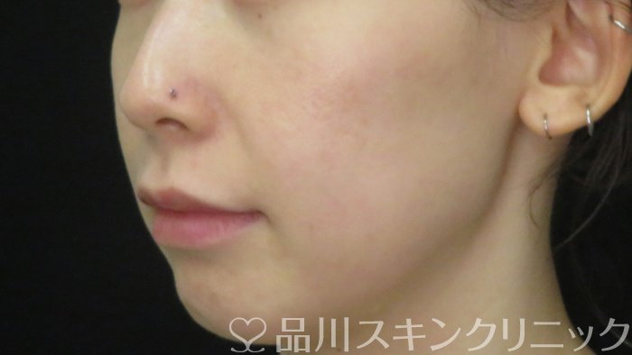症例NO.71576のAFTER写真