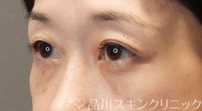 症例NO.69557のAFTER写真