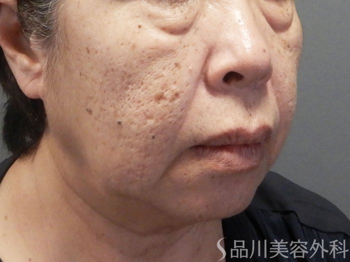 症例NO.70857のBEFORE写真