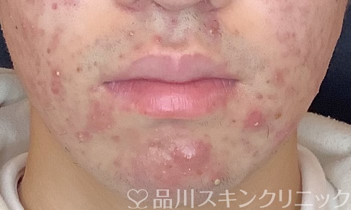 症例NO.70816のBEFORE写真