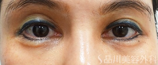症例NO.70105のBEFORE写真