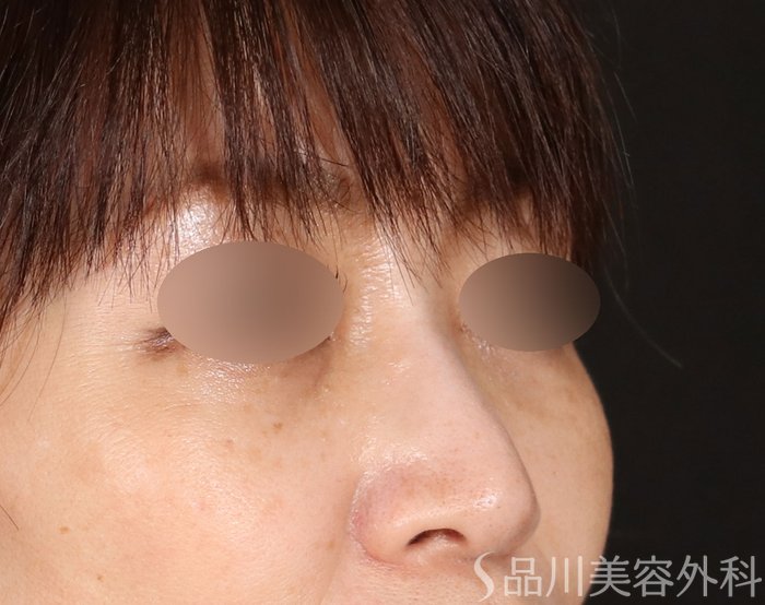 症例NO.71047のBEFORE写真
