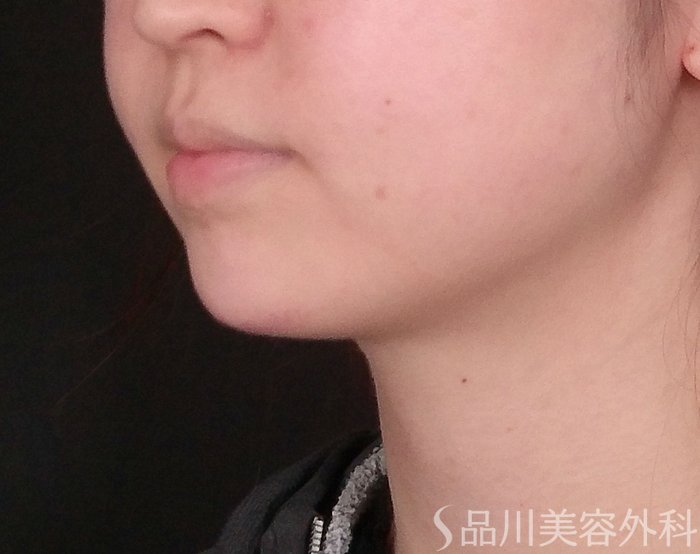 症例NO.69795のAFTER写真