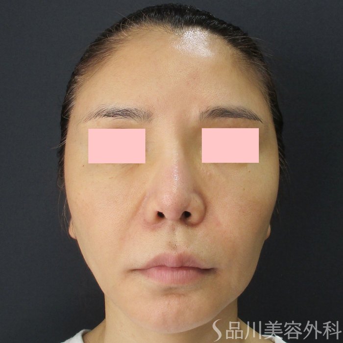 症例NO.72988のBEFORE写真