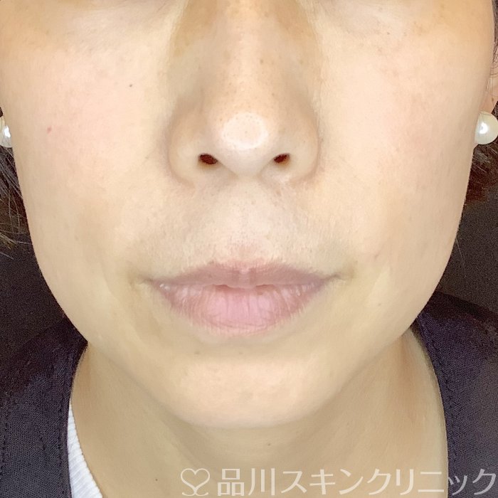 症例NO.62564のBEFORE写真