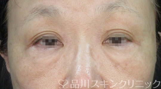 症例NO.71465のBEFORE写真