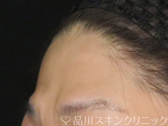 症例NO.65425のBEFORE写真