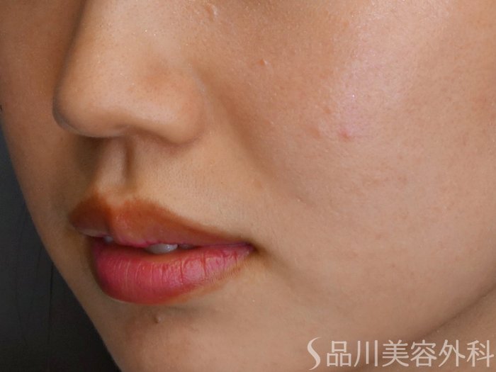 症例NO.65142のBEFORE写真