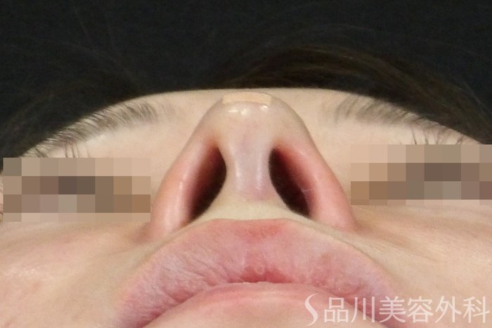 症例NO.70544のAFTER写真