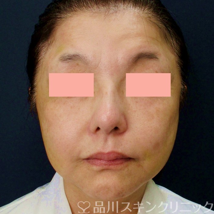 症例NO.73135のAFTER写真