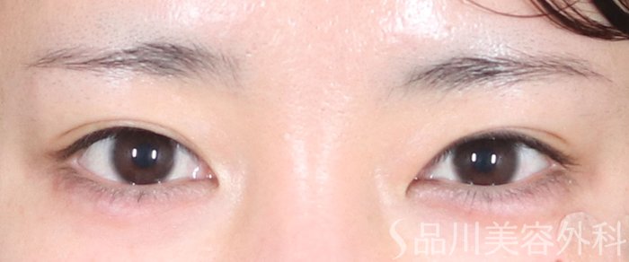 症例NO.73590のAFTER写真