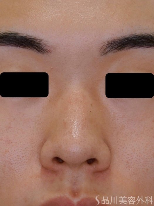症例NO.74497のBEFORE写真