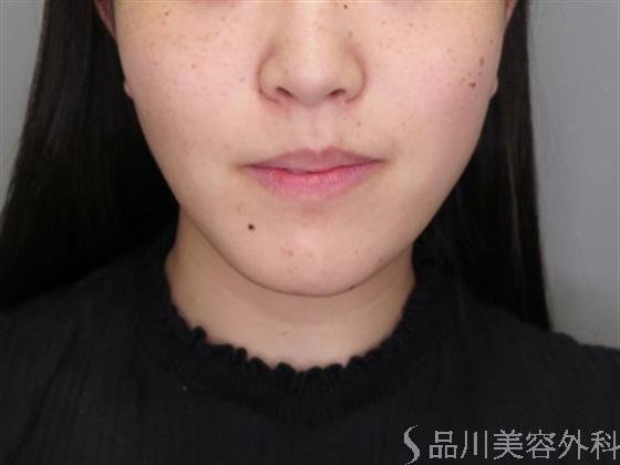 症例NO.48388のBEFORE写真