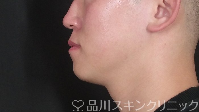 症例NO.72442のBEFORE写真