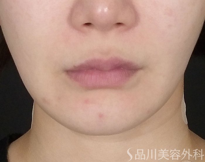 症例NO.65488のBEFORE写真