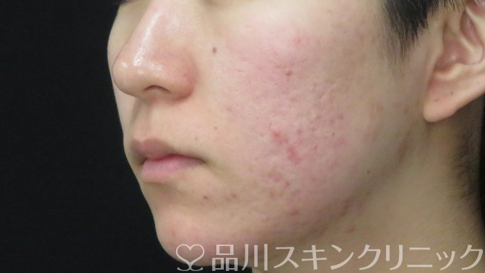 症例NO.71515のBEFORE写真