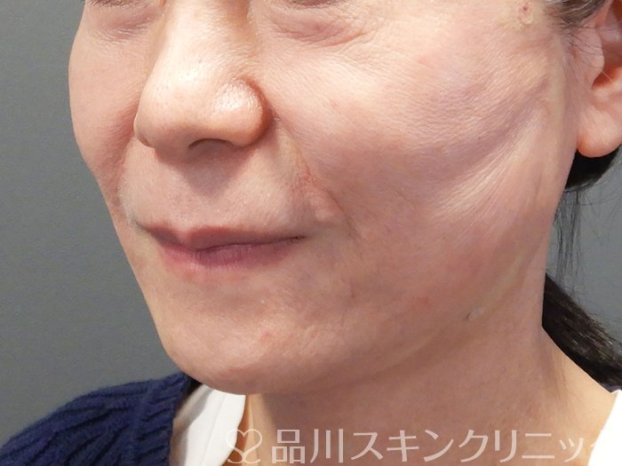 症例NO.73699のAFTER写真